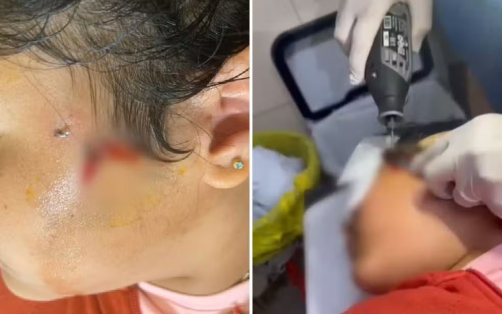 Crian&ccedil;a fica com anzol preso no rosto durante pescaria em Goi&aacute;s